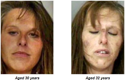 Photo of a woman in which she appears before and after start consuming heroin